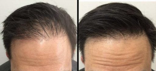Male prp for hair loss 512x234 Male prp for hair loss 512x234