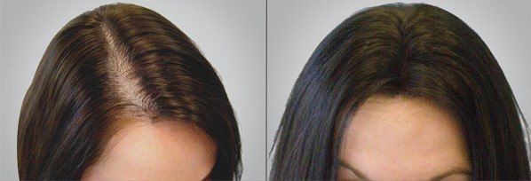 Female prp hair restoration Female prp hair restoration