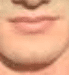 Chin philtrum 2