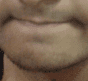 Chin philtrum bad 1
