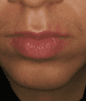 Chin philtrum bad 2