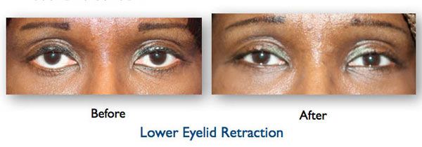 Eyelid complication for images lower eyelid retraction copy035