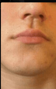 Philtrum mog 2