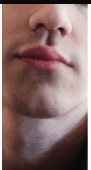 Philtrum mog 3