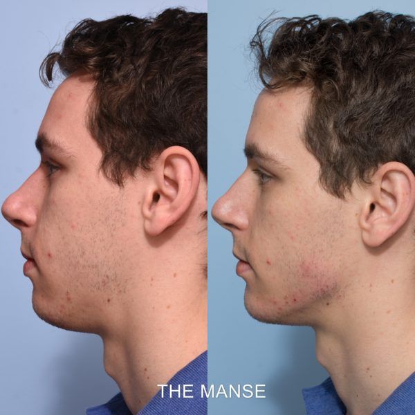 Before and after jawline and chin fillers 600x600