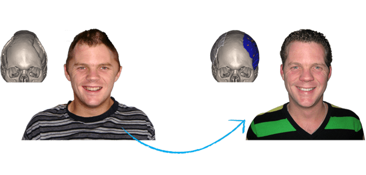 Xilloc Medical Marc Jacob before and after1a