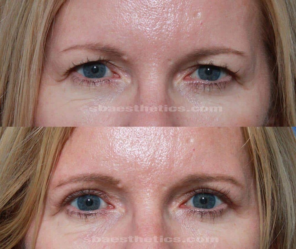Upper blepharoplasty before and after