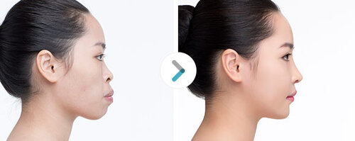 protruding-mouth_banobagi_2.jpg