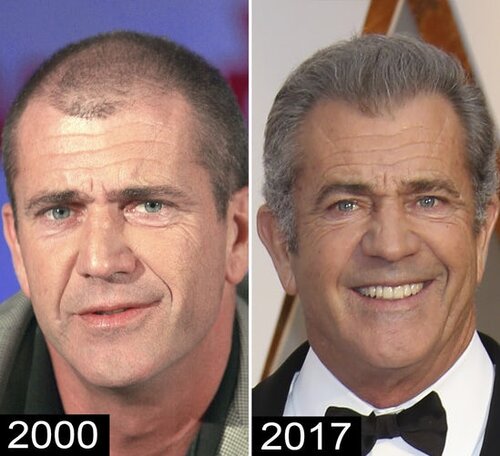 9-mel-gibson-celebrity-hair-transplants.jpg