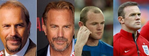 celebrity-hair-transplants.jpg