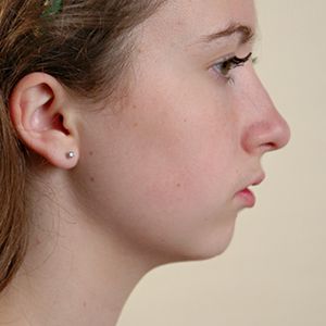 Jaw18