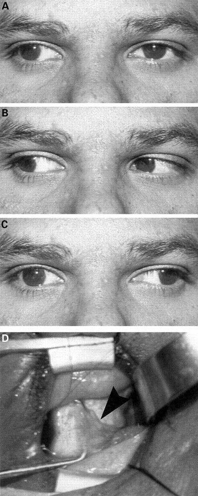 Bjophthalmol 2001 May 85 5 598 F4large