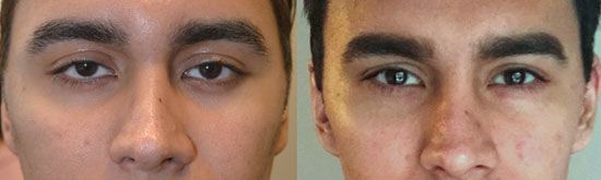 Eye area