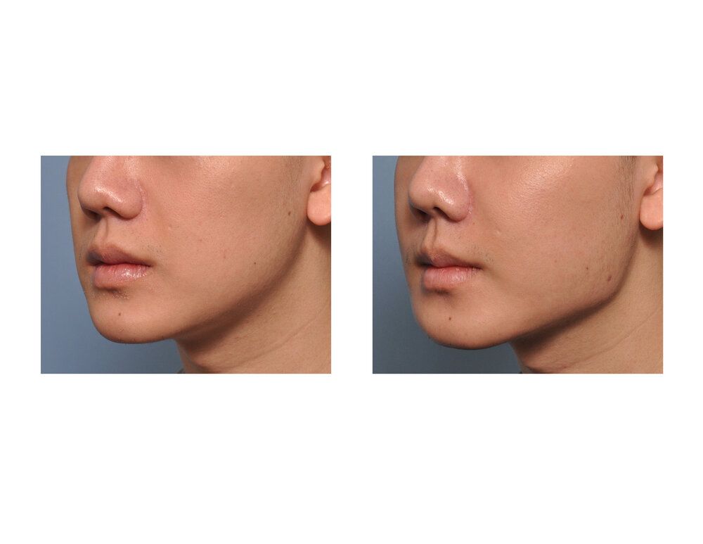 Jaw Angle Implant Results oblique view1