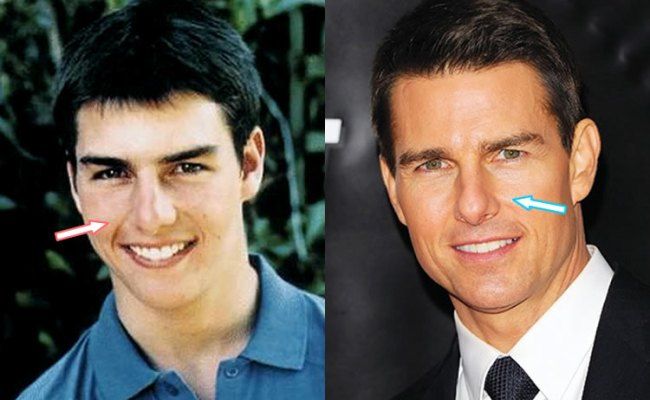 Tom cruise nose job