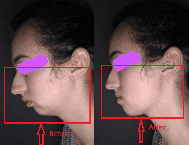 Mewing transformation 1