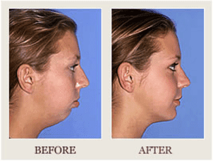 Jaw surgery before after overbite