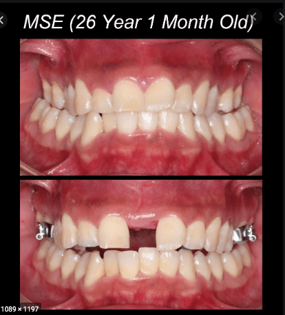 Mse
