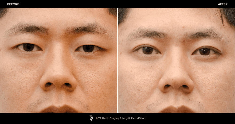 41002 Asian Double Eyelid 1