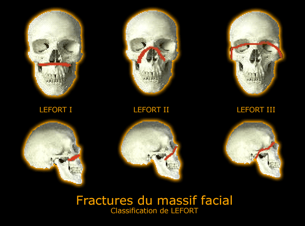 LEFORT 4eaad