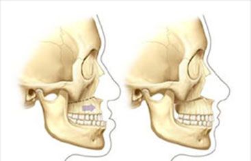 Maxillofacia osteotomie de lefort