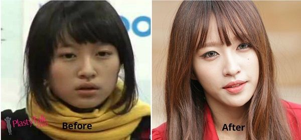 Ahn Hee Yeon aka Hani Plastic Surgery EXID Kpop