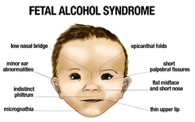 Fetal alcohol syndrom
