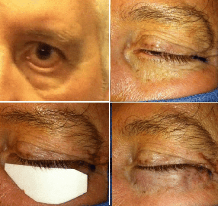 Spacer graft placed in the lower eyelid