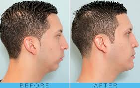 Chin Implant Vs Sliding Genioplasty I'd... - Pearlmax Oral Surgery ...