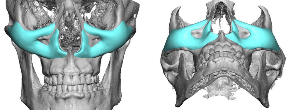 8 Custom infraorbital malar maxillary imlpant designs Dr Barry Eppley Indianapolis 1024x384 1