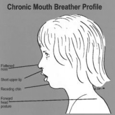 Mouthbreatherprofile 1