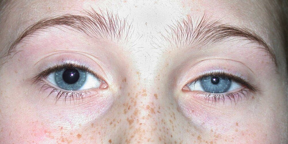 613 anisocoria due to horner syndrome springer high