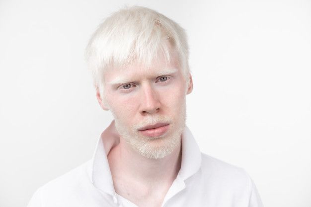 Albino man studio dressed t shirt isolated white 91014 2073