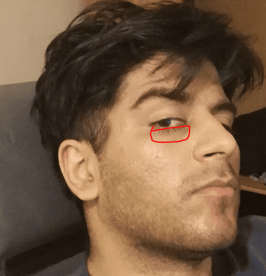 Infraorbital