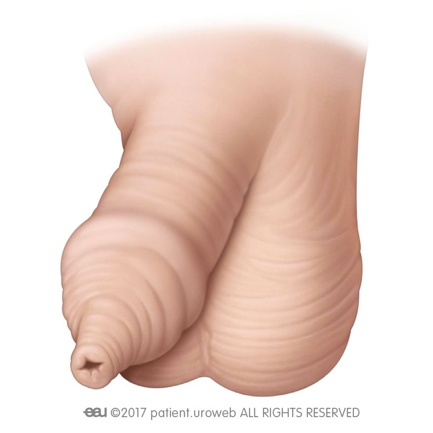 Phimoses 01 ENG figure 1