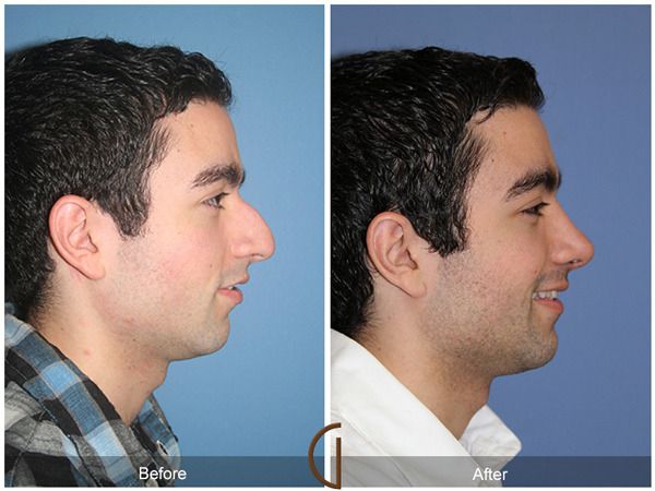 Orange County Newport Beach Ethnic Rhinoplasty 58 R zps67ayqpbm