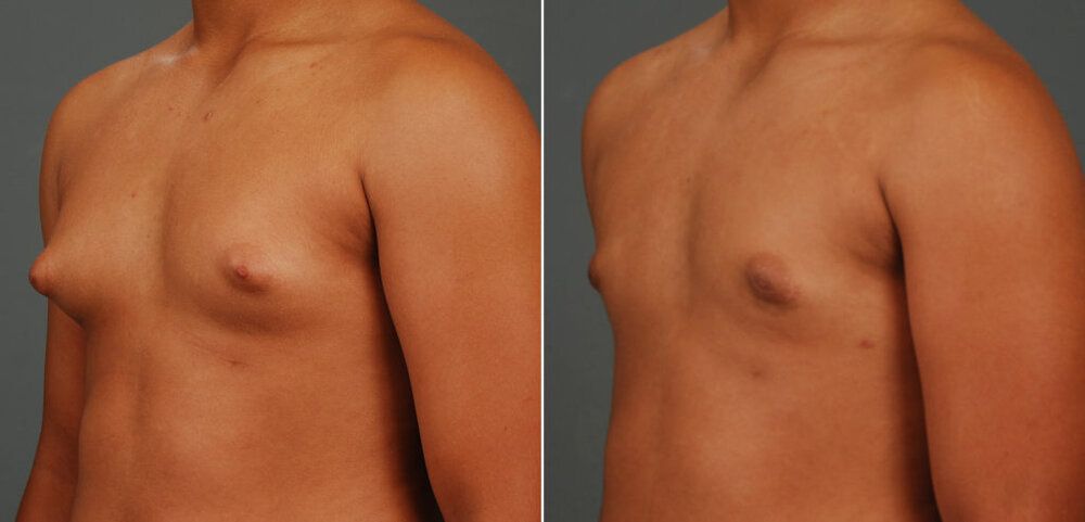 Patient 11216 gynecomastia before after 1024x492