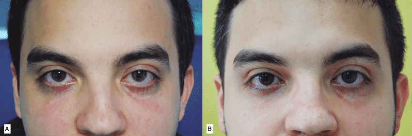A Color photograph showing the bilateral lower scleral show before HA injection Frontal