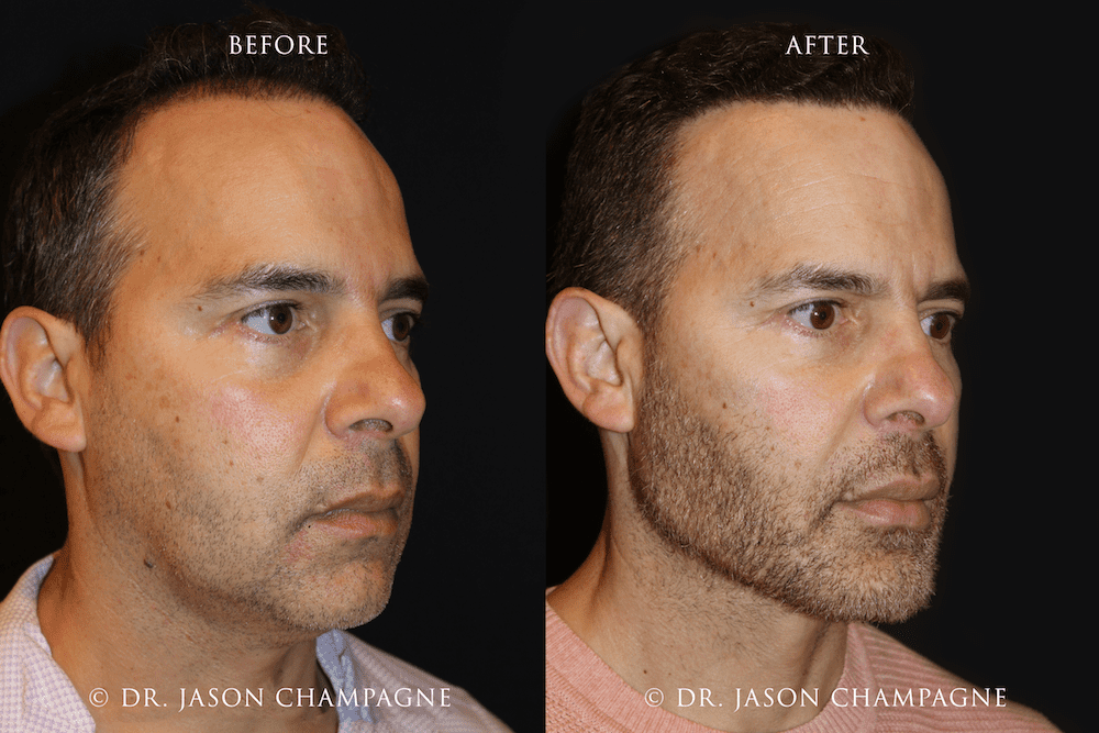 Custom Chin and Jaw Before and After 3 4