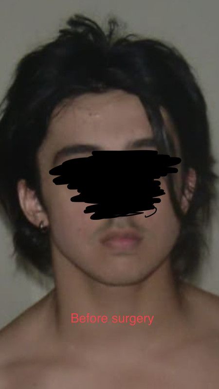 Before chin wing