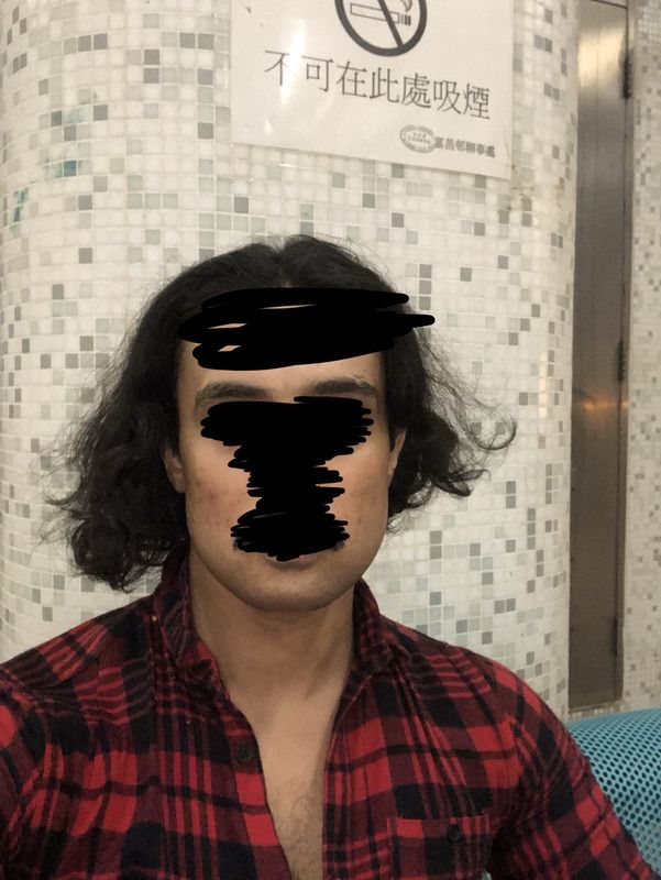 After chin wing swelling down