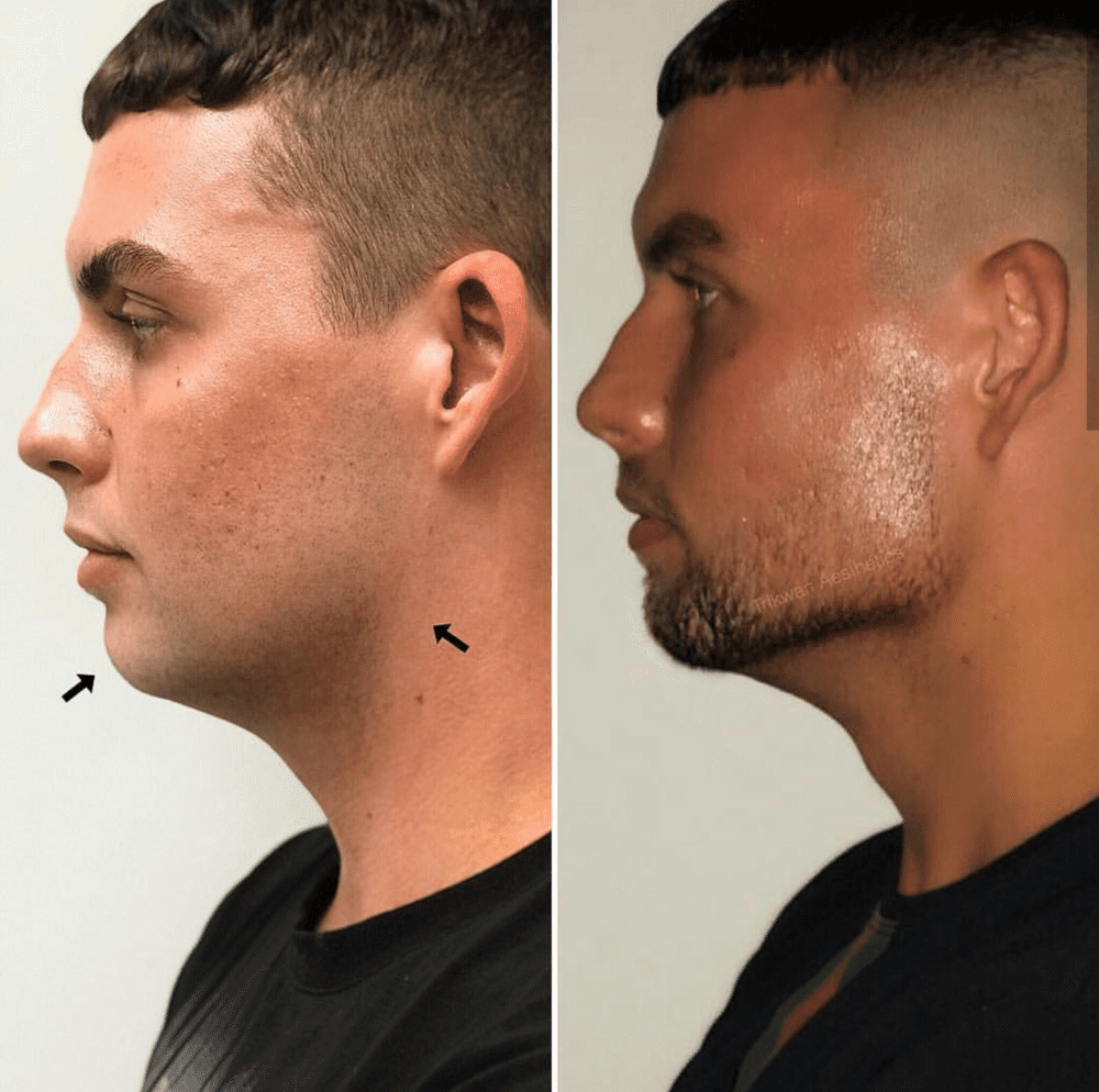 JAWLINE
