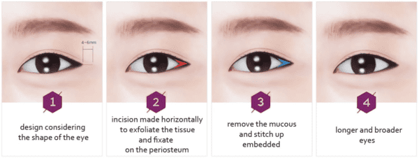 Lateral canthoplasty procedure e1578012250738