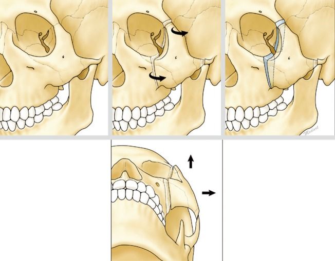 Tripod osteotomy Schema of orbital expansion by tripod osteotomy