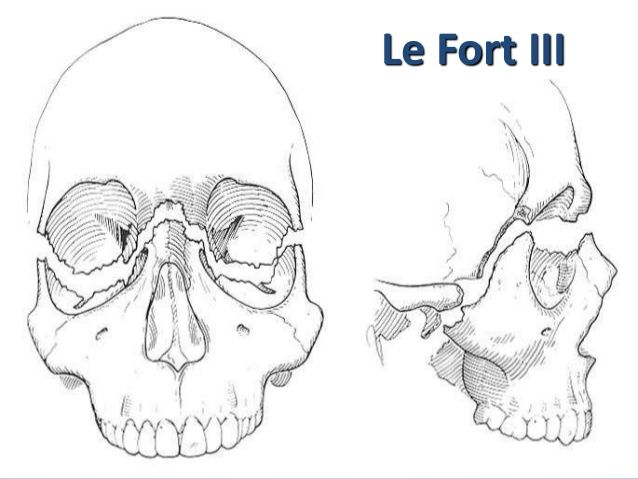 Maxillary and periorbital fractures 30 638