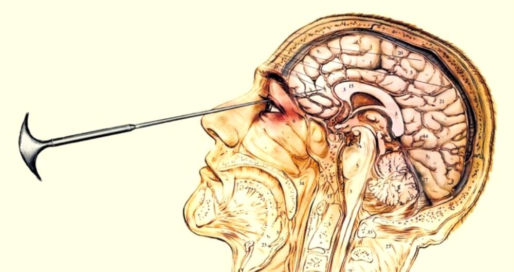 Lobotomy 1