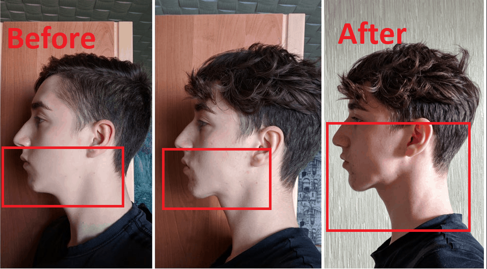 Mewing progress for a 17 year old young man