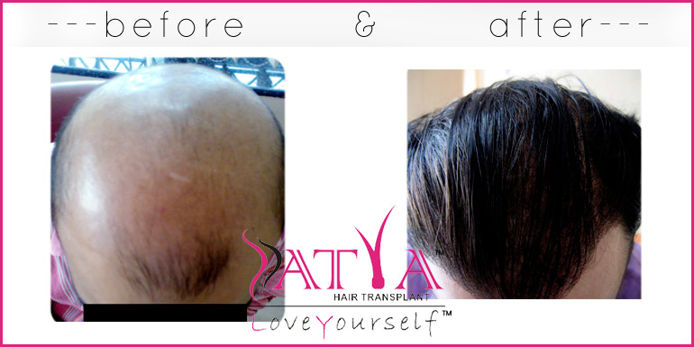Multiple session of synthetic hair implant