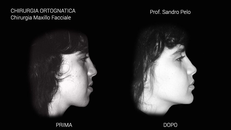 1slider chirurgia ortognatica