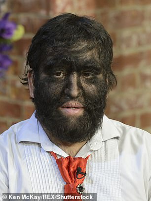 17963242 7418535 Jesus Aceves known as wolf boy suffers from the rare disease and a 72 1567414